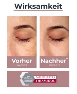 Tinh chất trị nám má tàn nhang Eucerin Anti-Pigment Dual Serum, 30ml