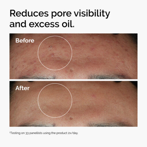 Tinh chất trị mụn The Ordinary Niacinamide 10% + Zinc 1%, 30ml