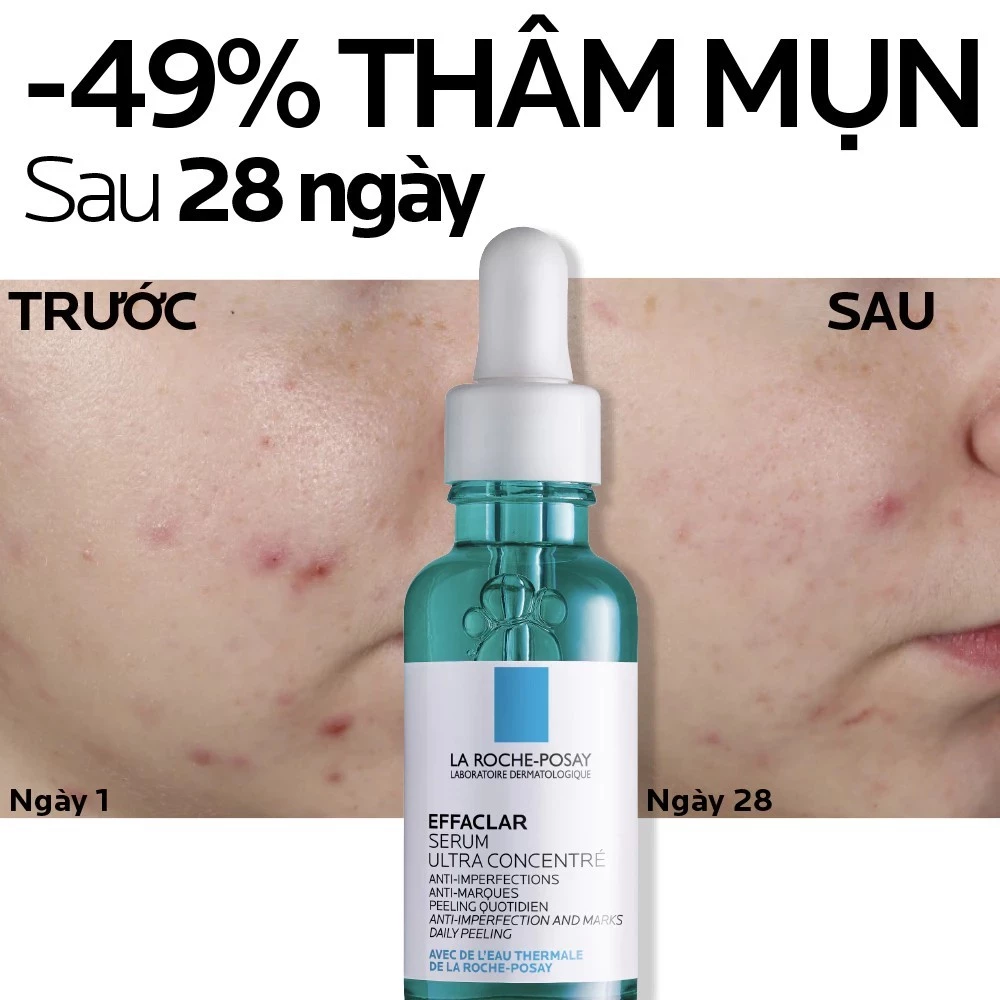 Tinh chất La Roche-Posay Effaclar Ultra Concentrated Serum trị mụn, giảm thâm, thu nhỏ lỗ chân lông, 30ml Tinh chất La Roche-Posay Effaclar Ultra Concentrated Serum trị mụn, giảm thâm, thu nhỏ lỗ chân lông, 30ml